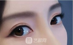 全切双眼皮二次修复时间