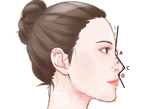 濡白天使隆鼻会变宽吗?核