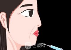 弗缦胶原蛋白和双美的区别哪些?从注射部位、维持时间、成分等方面解析
