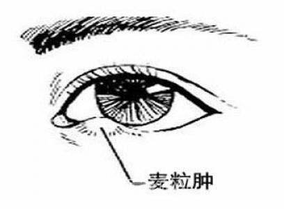 麦粒肿去除