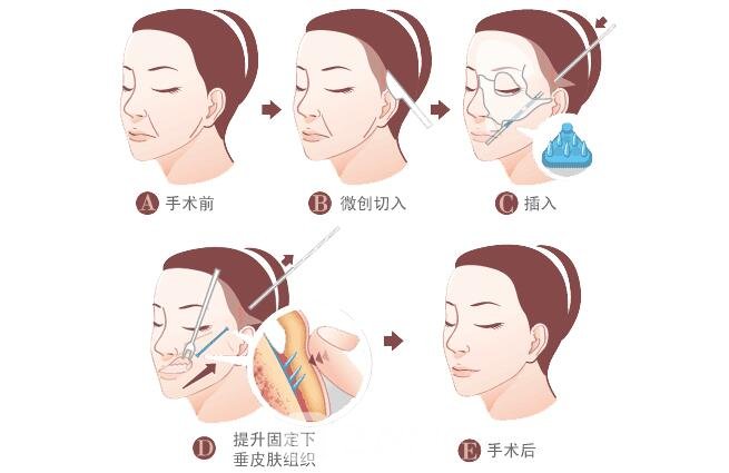 筋膜悬吊除皱