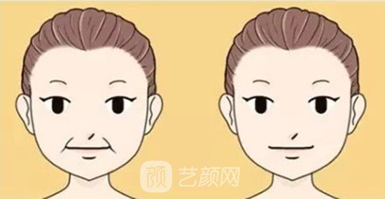玻尿酸去静态纹