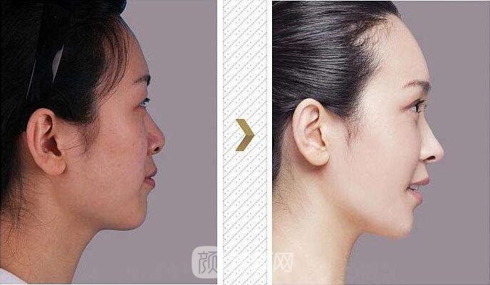 耳软骨复合隆鼻