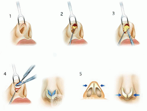 鼻头组织去除