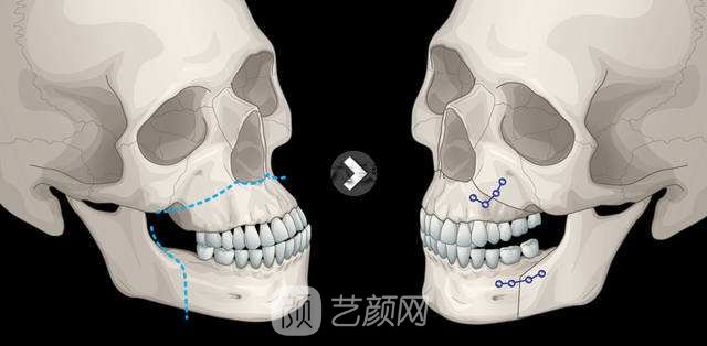 双鄂手术