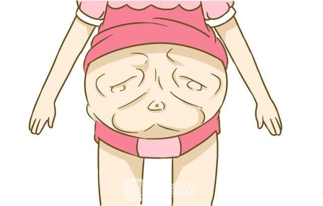 腹壁松弛整形