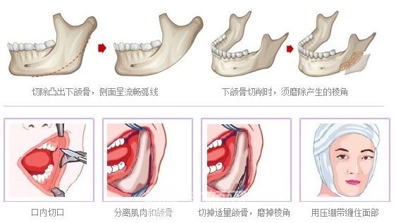 磨骨