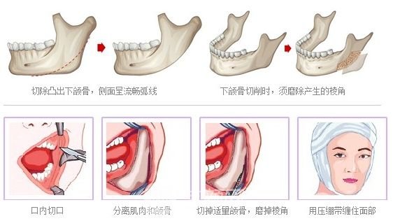 磨骨