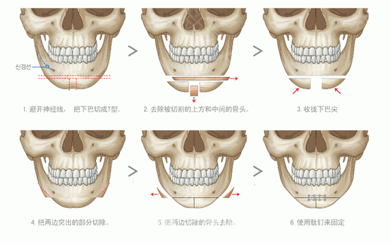 下巴截骨术