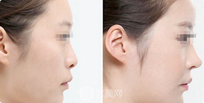 腹直肌筋膜隆鼻